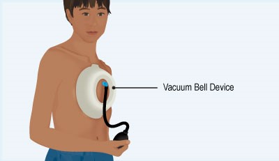 Vakum Sistemi (Vacuum Bell) uygulaması